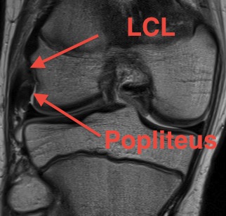 Popliteus Insertion